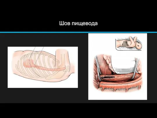 Шов пищевода