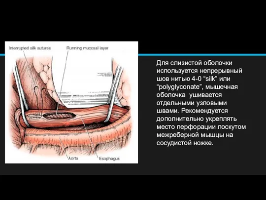 Для слизистой оболочки используется непрерывный шов нитью 4-0 “silk” или “polyglyconate”, мышечная