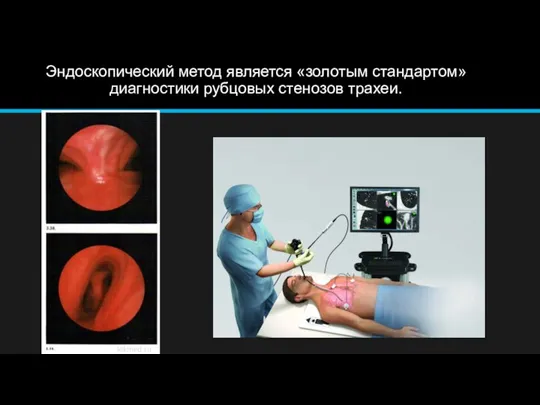 Эндоскопический метод является «золотым стандартом» диагностики рубцовых стенозов трахеи.