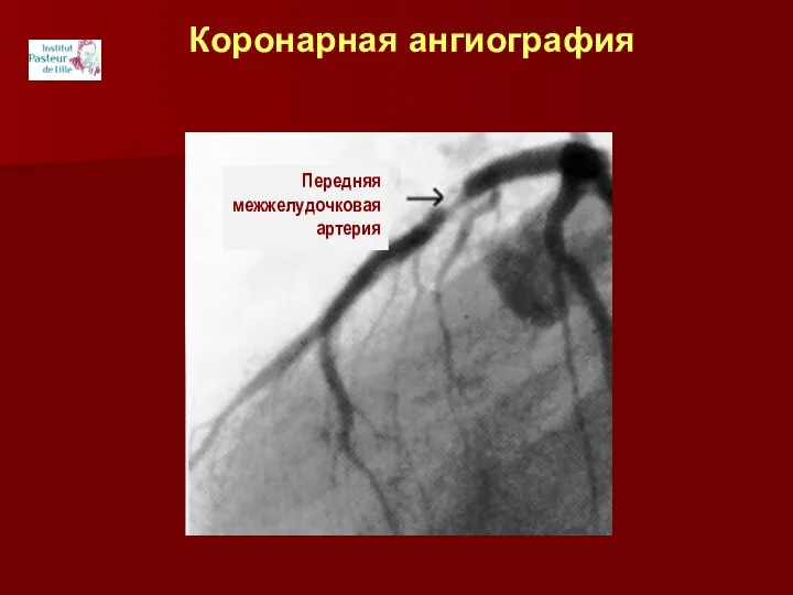 Коронарная ангиография Передняя межжелудочковая артерия