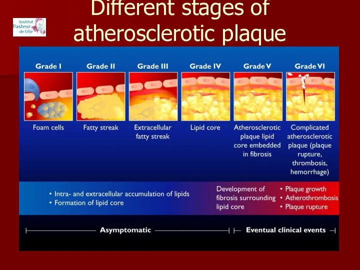 Different stages of atherosclerotic plaque development