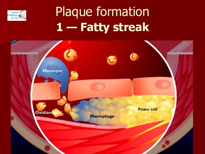 Plaque formation 1 — Fatty streak