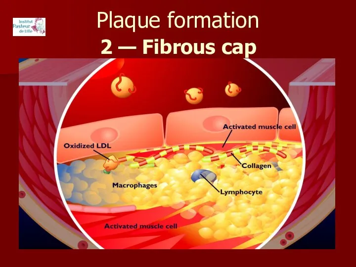 Plaque formation 2 — Fibrous cap