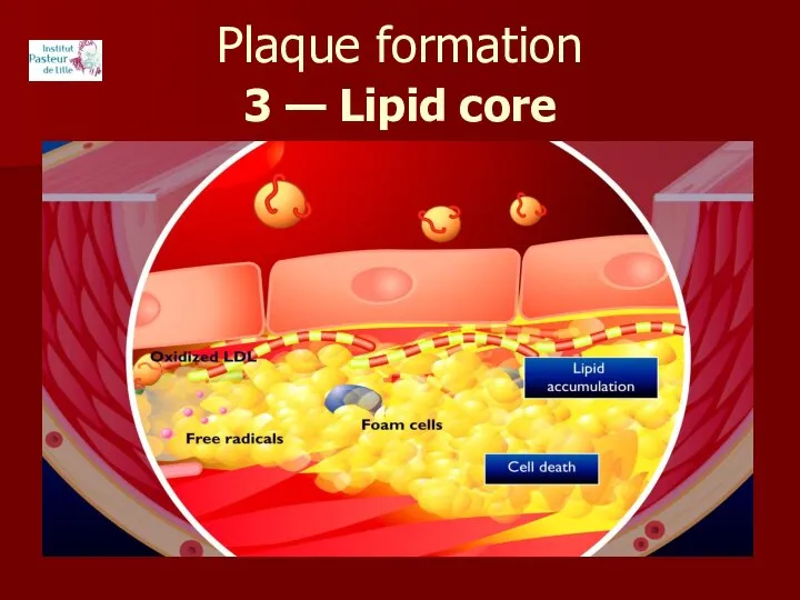 Plaque formation 3 — Lipid core