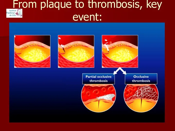 From plaque to thrombosis, key event: plaque rupture