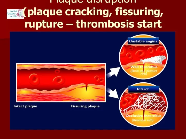 Plaque disruption (plaque cracking, fissuring, rupture – thrombosis start point)