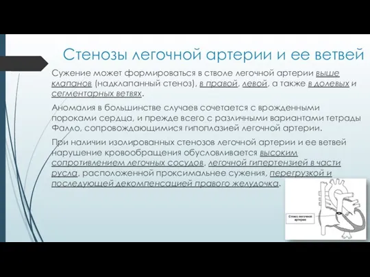 Стенозы легочной артерии и ее ветвей Сужение может формироваться в стволе легочной