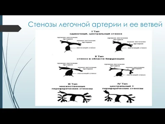 Стенозы легочной артерии и ее ветвей