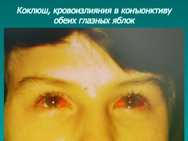 Коклюш, кровоизлияния в конъюнктиву обеих глазных яблок