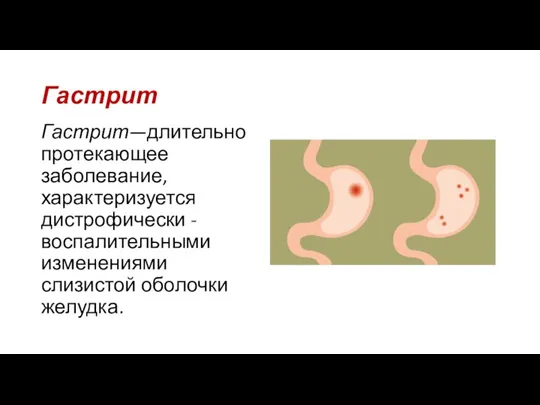 Гастрит Гастрит—длительно протекающее заболевание, характеризуется дистрофически -воспалительными изменениями слизистой оболочки желудка.