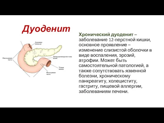 Дуоденит Хронический дуоденит – заболевание 12-перстной кишки, основное проявление – изменение слизистой