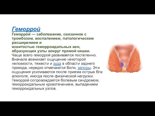 Геморрой Геморро́й — заболевание, связанное с тромбозом, воспалением, патологическим расширением и извитостью