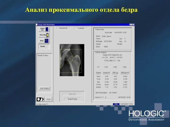 Анализ проксимального отдела бедра