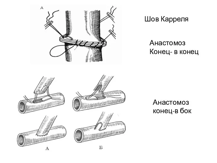 Шов Карреля Анастомоз конец-в бок Анастомоз Конец- в конец