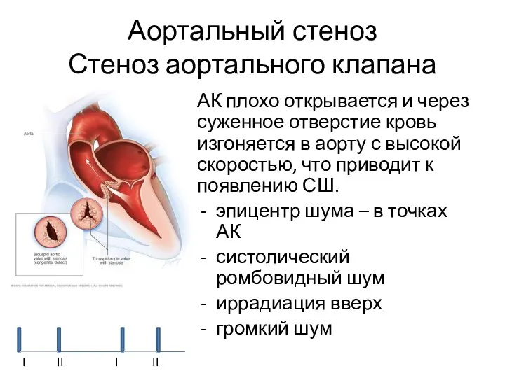 Аортальный стеноз Стеноз аортального клапана АК плохо открывается и через суженное отверстие