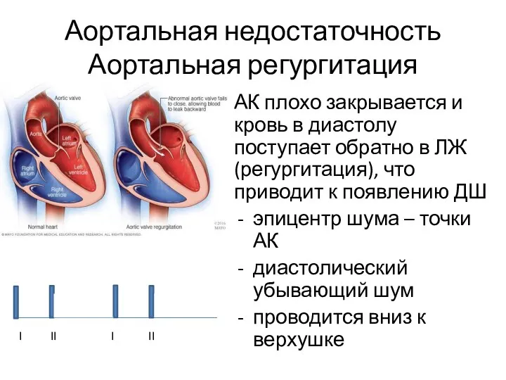 Аортальная недостаточность Аортальная регургитация АК плохо закрывается и кровь в диастолу поступает