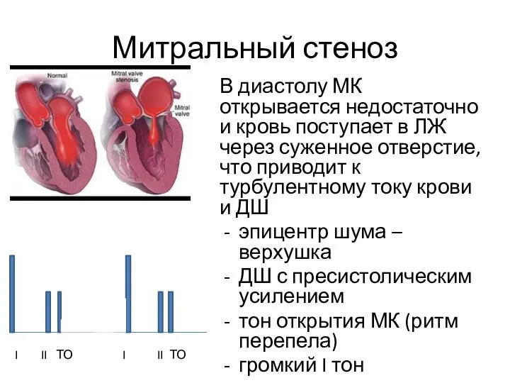 Митральный стеноз В диастолу МК открывается недостаточно и кровь поступает в ЛЖ