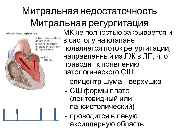 Митральная недостаточность Митральная регургитация МК не полностью закрывается и в систолу на