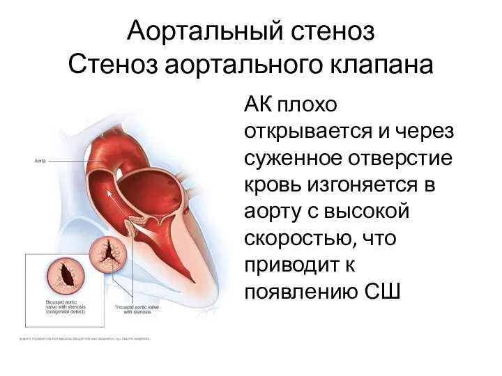 Аортальный стеноз Стеноз аортального клапана АК плохо открывается и через суженное отверстие