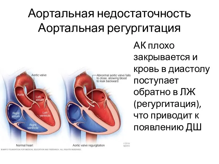 Аортальная недостаточность Аортальная регургитация АК плохо закрывается и кровь в диастолу поступает