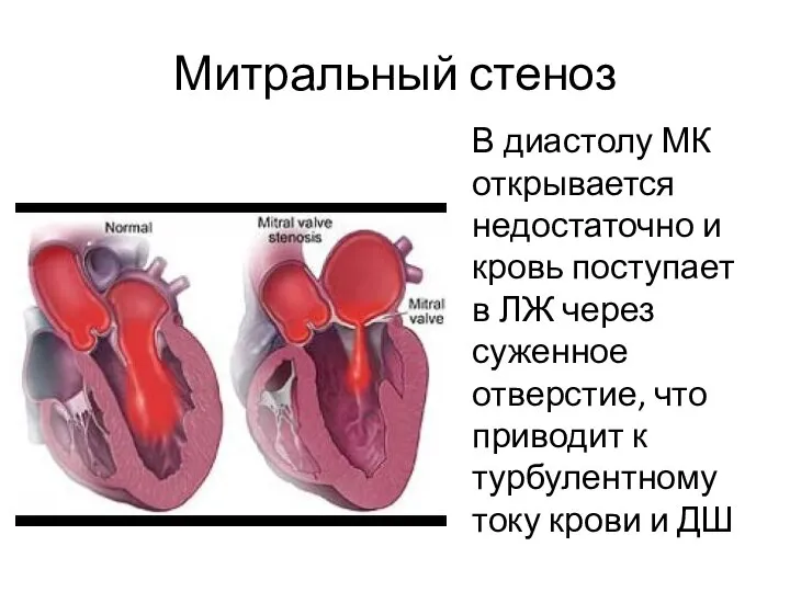 Митральный стеноз В диастолу МК открывается недостаточно и кровь поступает в ЛЖ