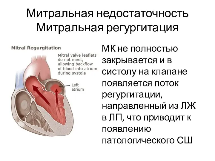 Митральная недостаточность Митральная регургитация МК не полностью закрывается и в систолу на