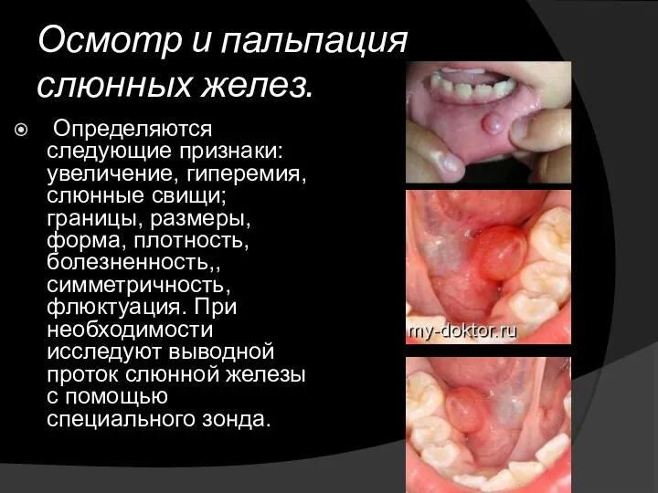 Осмотр и пальпация слюнных желез. Определяются следующие признаки: увеличение, гиперемия, слюнные свищи;