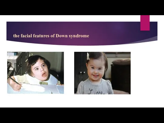 the facial features of Down syndrome.