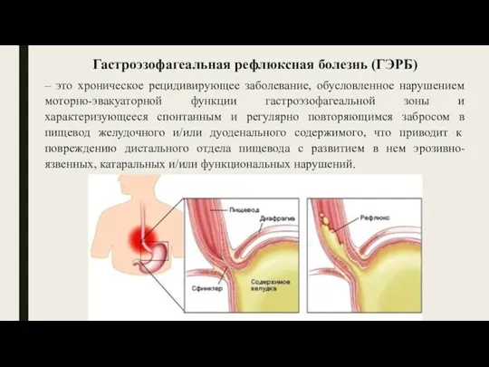 Гастроэзофагеальная рефлюксная болезнь (ГЭРБ) – это хроническое рецидивирующее заболевание, обусловленное нарушением моторно-эвакуаторной