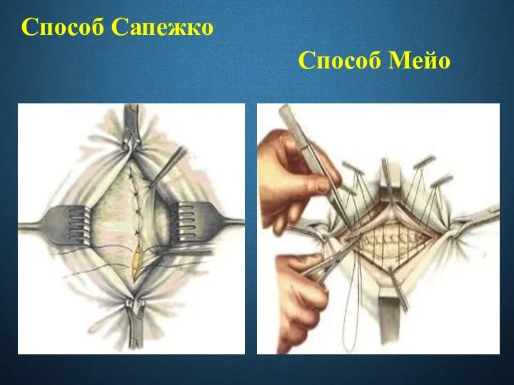 Способ Сапежко Способ Мейо