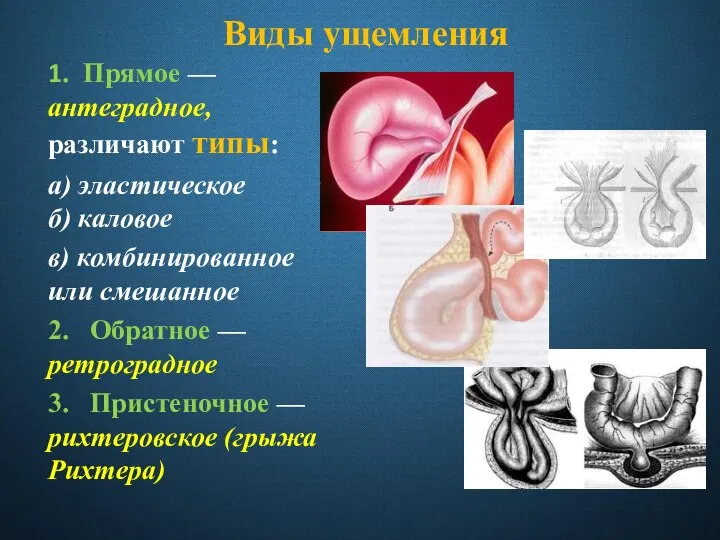 Виды ущемления 1. Прямое — антеградное, различают типы: а) эластическое б) каловое