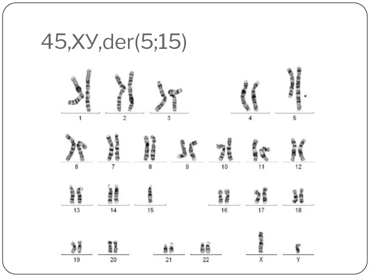 45,ХУ,der(5;15)