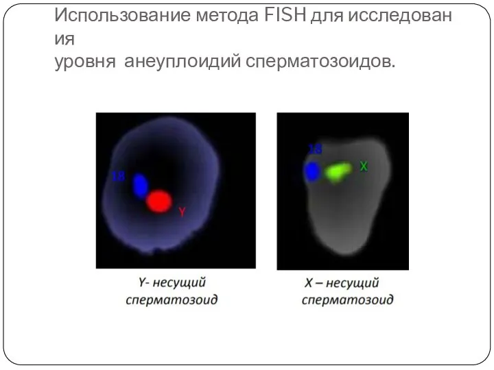 Использование метода FISH для исследования уровня анеуплоидий сперматозоидов.