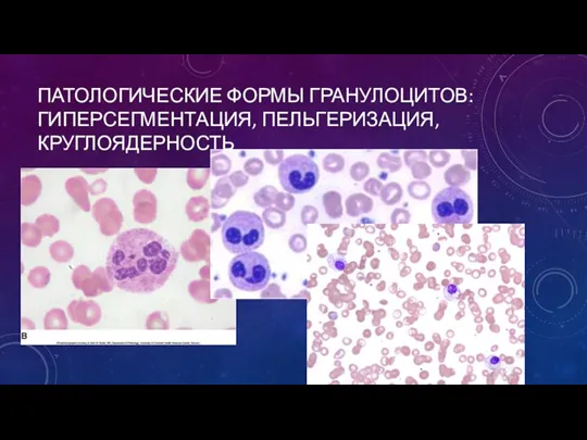 ПАТОЛОГИЧЕСКИЕ ФОРМЫ ГРАНУЛОЦИТОВ:ГИПЕРСЕГМЕНТАЦИЯ, ПЕЛЬГЕРИЗАЦИЯ, КРУГЛОЯДЕРНОСТЬ