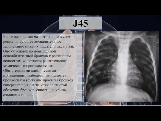 J45 Бронхиальная астма – это хроническое рецидивирующее воспалительное заболевание нижних дыхательных путей.