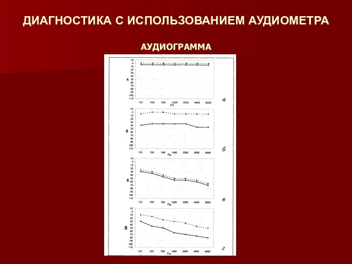 ДИАГНОСТИКА С ИСПОЛЬЗОВАНИЕМ АУДИОМЕТРА АУДИОГРАММА