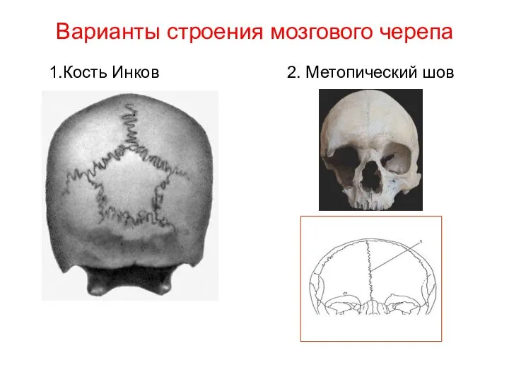 Варианты строения мозгового черепа 1.Кость Инков 2. Метопический шов