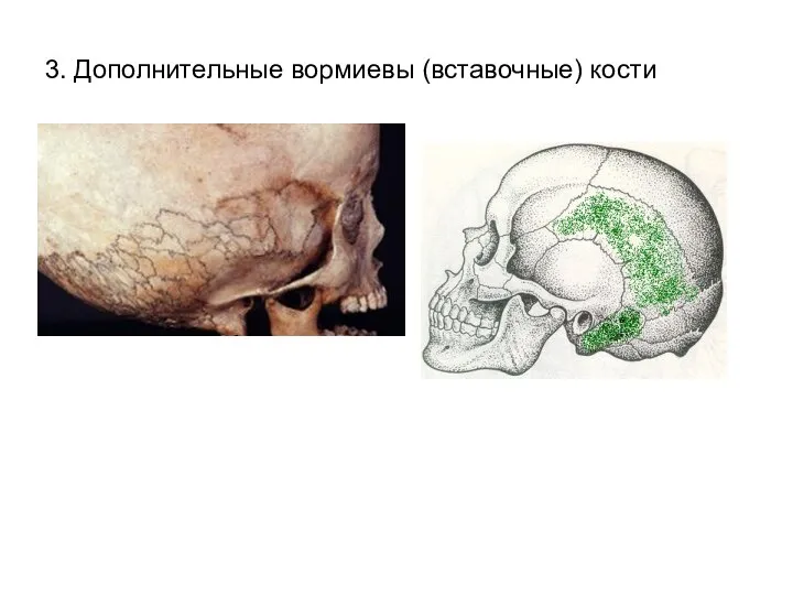 3. Дополнительные вормиевы (вставочные) кости