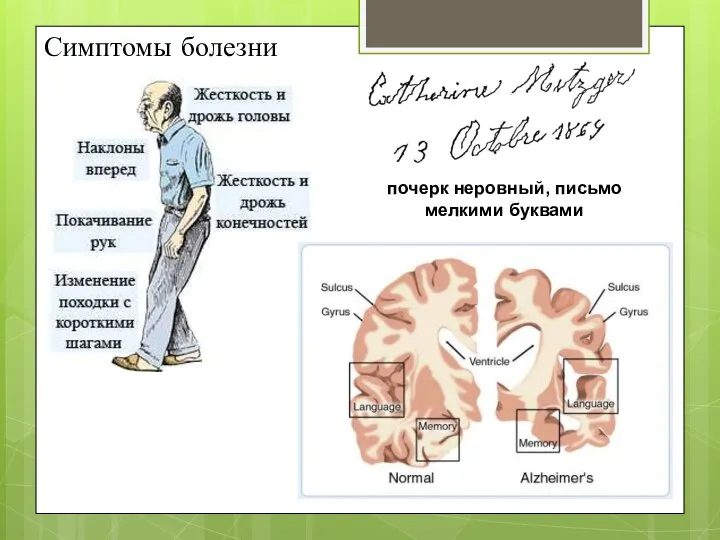 Симптомы болезни почерк неровный, письмо мелкими буквами