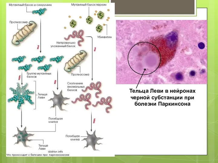 Тельца Леви в нейронах черной субстанции при болезни Паркинсона