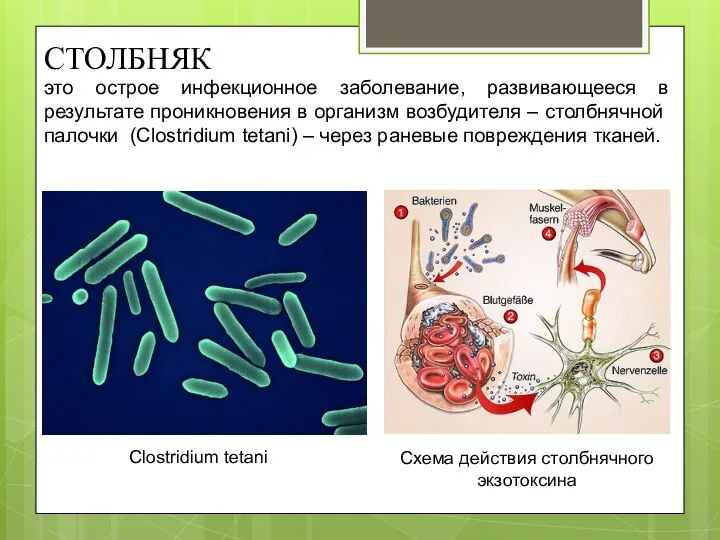 СТОЛБНЯК это острое инфекционное заболевание, развивающееся в результате проникновения в организм возбудителя