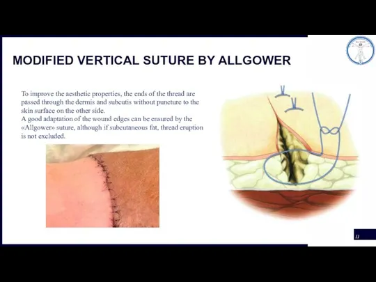 MODIFIED VERTICAL SUTURE BY ALLGOWER To improve the aesthetic properties, the ends