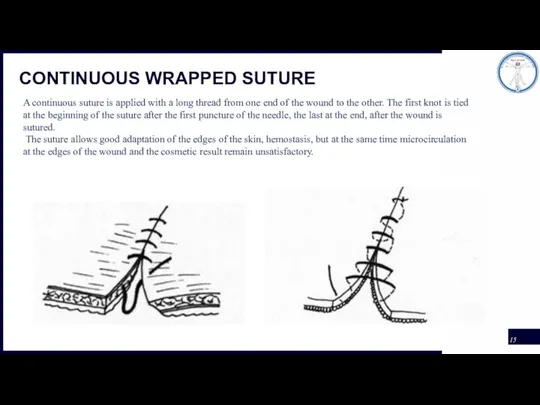 CONTINUOUS WRAPPED SUTURE A continuous suture is applied with a long thread