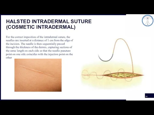 HALSTED INTRADERMAL SUTURE (COSMETIC INTRADERMAL) For the correct imposition of the intradermal