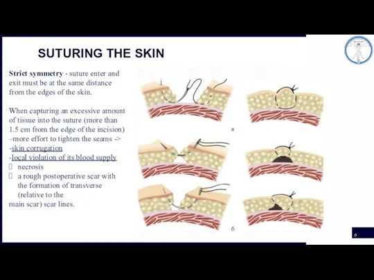 SUTURING THE SKIN Strict symmetry - suture enter and exit must be