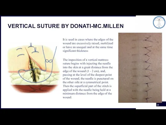 VERTICAL SUTURE BY DONATI-MC.MILLEN It is used in cases where the edges