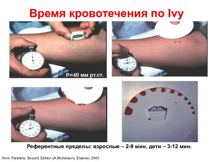 Время кровотечения по Ivy ЭКО-МЕД-СМ from: Platelets. Second Edition (A.Michelson). Elseiver, 2007.