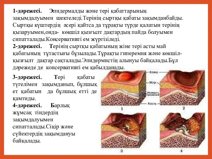 1-дәрежесі. Эпидермалды және тері қабаттарының зақымдалуымен шектеледі.Терінің сыртқы қабаты зақымданбайды.Сыртқы күштердің әсері