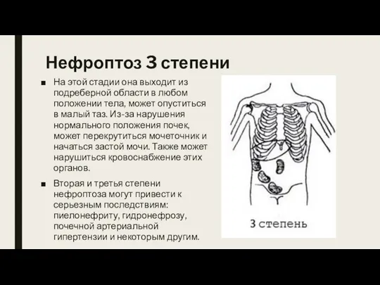 Нефроптоз 3 степени На этой стадии она выходит из подреберной области в