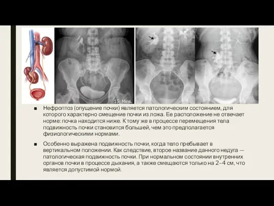 Нефроптоз (опущение почки) является патологическим состоянием, для которого характерно смещение почки из